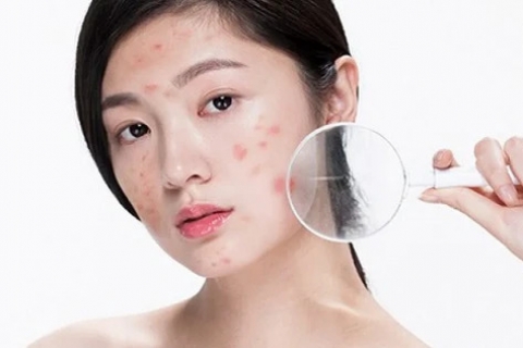 Mách bạn 10+ bí quyết để nhanh lành mụn chỉ sau 1 đêm