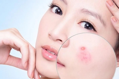 Top 7 nguyên nhân gây mụn phổ biến và cách điều trị dứt điểm